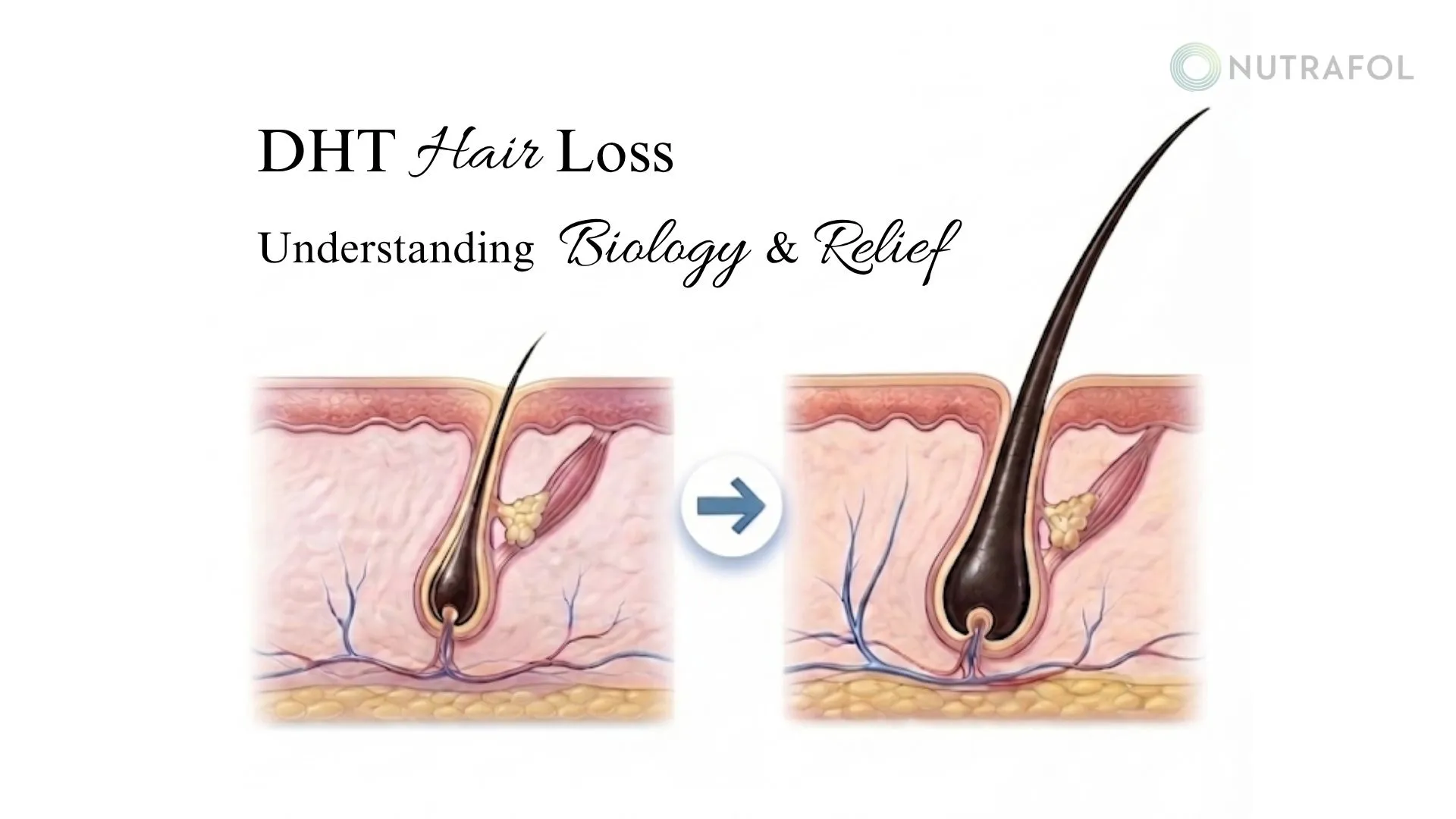 What Is DHT Hair Loss: Causes, Biology, and Proven Solutions
